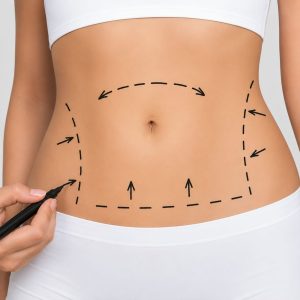 Lipolaser Laser Ambulatoria 1 Zona (Abdomen completo, flancos o rollito del sosten
